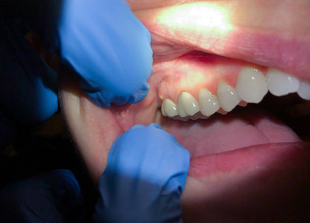 Best Emergency Dentist for Lost Fillings or Crowns in Webster Groves, MO